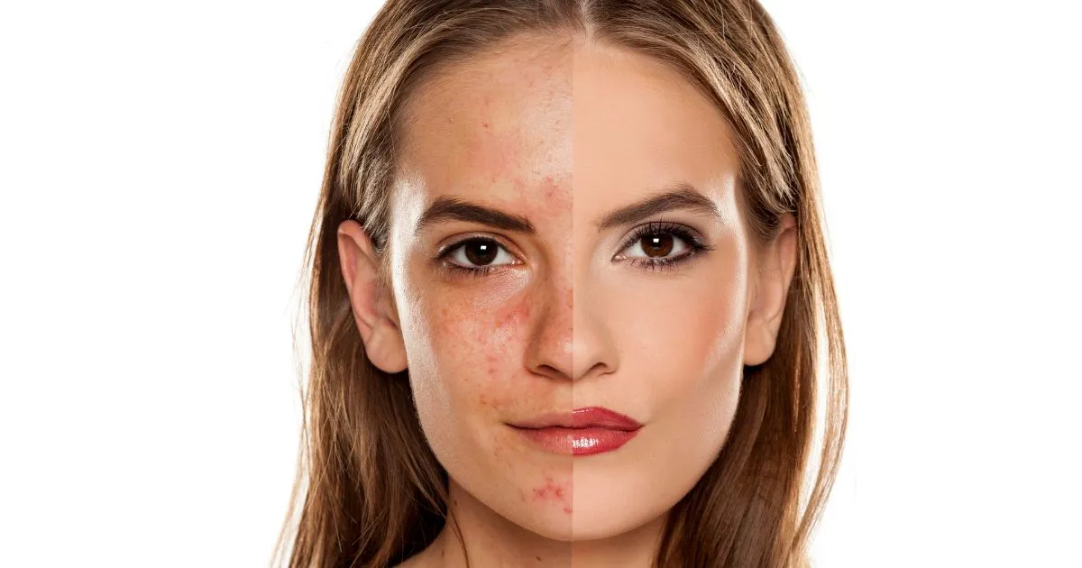 CO2 Laser vs Microneedling comparison for skin rejuvenation in Lee's Summit, MO